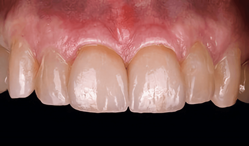 Patient Result 1, after treatment at Ottawa Dental Centre