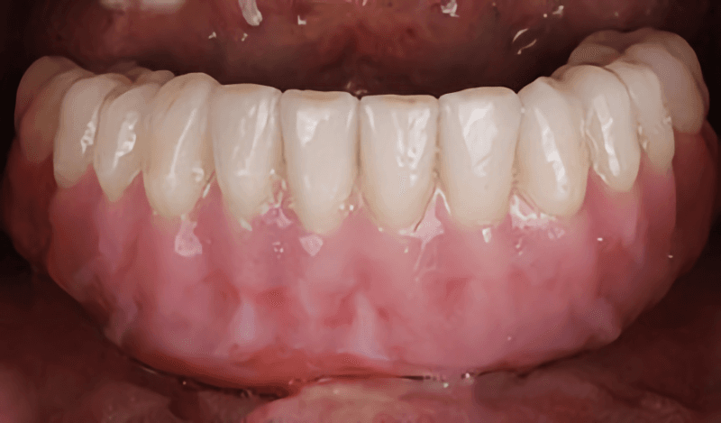 Patient Result 2, after treatment at Ottawa Dental Centre