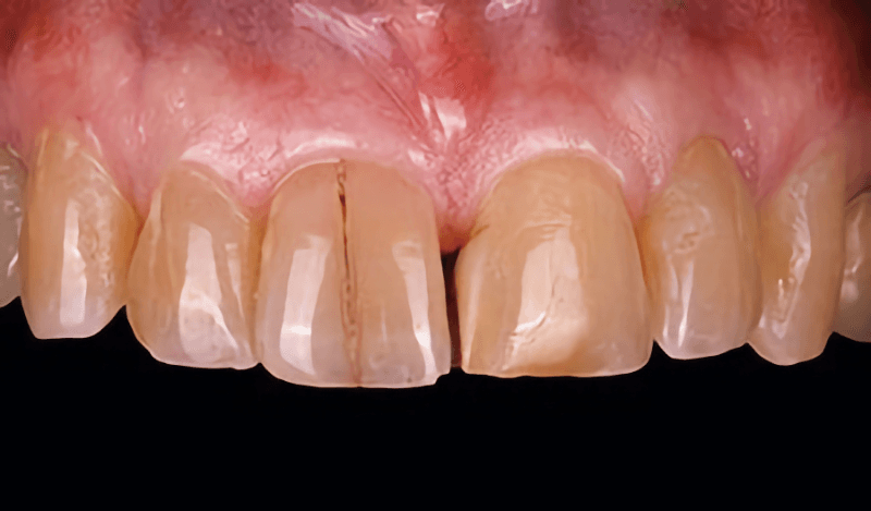Patient Result 1, before treatment at Ottawa Dental Centre