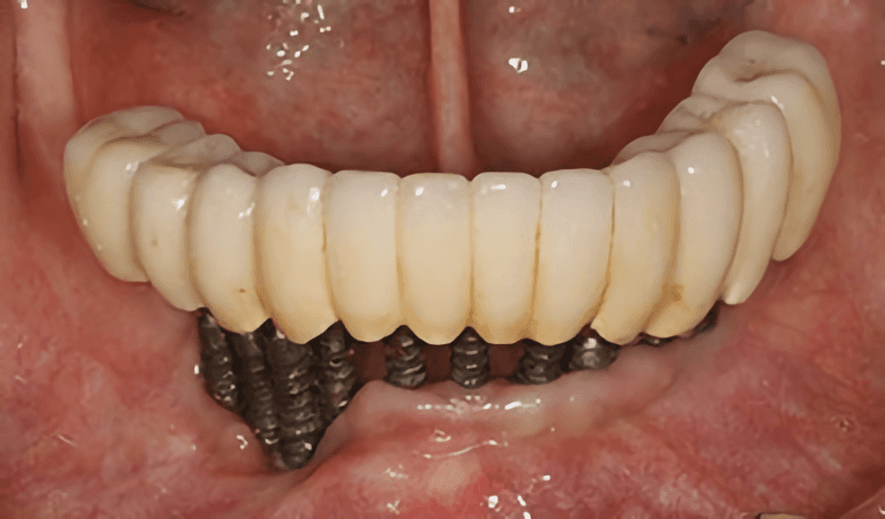 Patient Result 2, before treatment at Ottawa Dental Centre