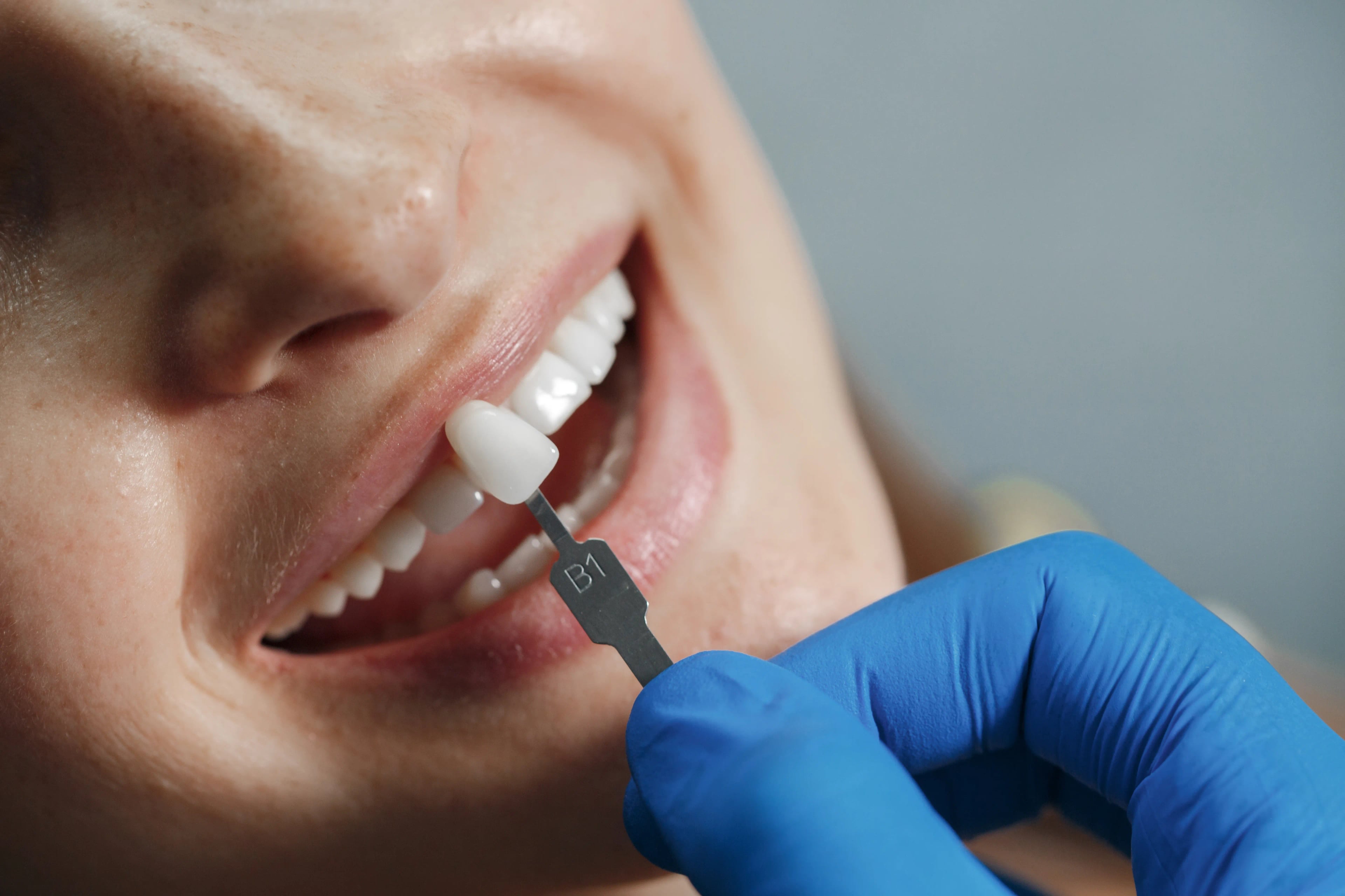 Ottawa Dental Centre Porcelain Veneers